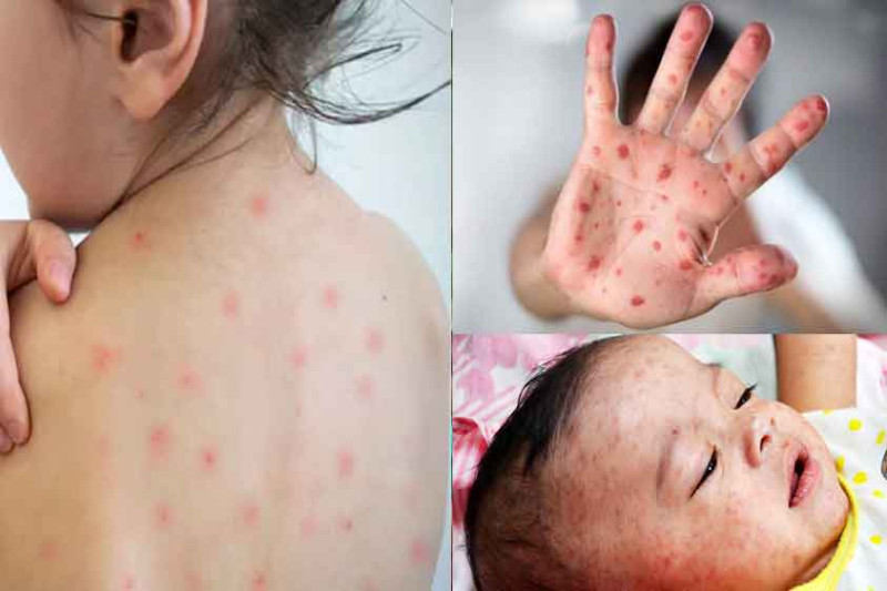 শিশুদের হাম, লক্ষণ, প্রতিকার